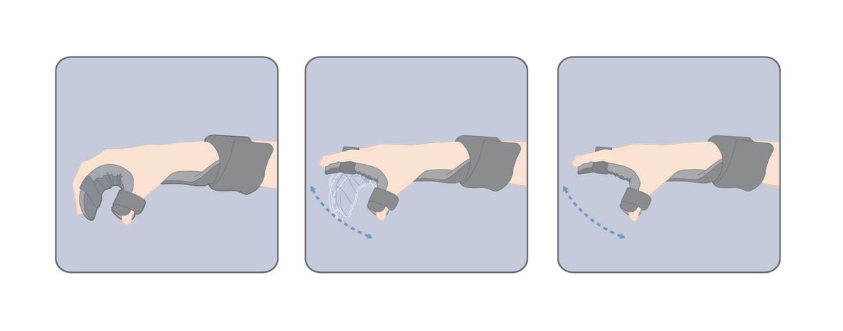 Mathi Resting Splint | Orthotix | UK | Orthotix Limited T/a Orthotix ...